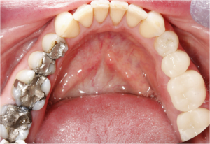 CEREC Same Day Crowns CEREC Same Day Crowns