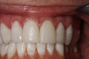 Veneers Bangor