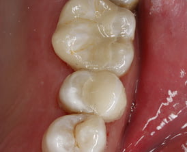 Cerec Same Day Crowns Cerec Same Day Crowns