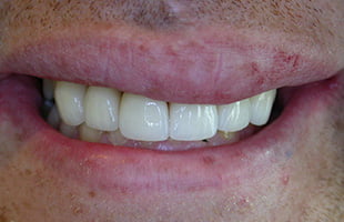 Porcelain Crowns Porcelain Crowns