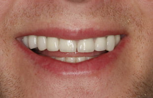 Ceramic Crowns Ceramic Crowns