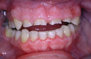 Porcelain Crowns Porcelain Crowns