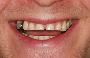 Ceramic Crowns Ceramic Crowns