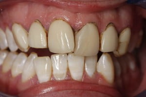 Veneers Bangor