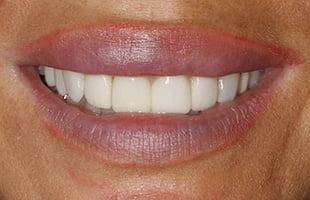 Dental Veneers