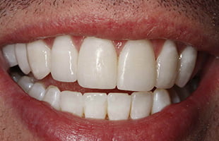 Cosmetic Veneers