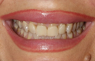 Dental Veneers