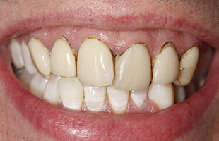 Cosmetic Veneers