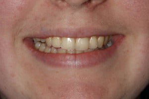 Tooth Trauma Tooth Trauma