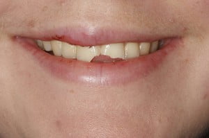 Tooth Trauma Tooth Trauma